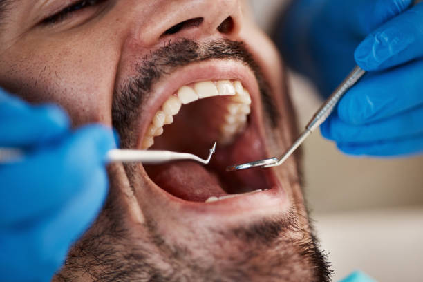 Best Emergency Tooth Extraction in Hunter, OH